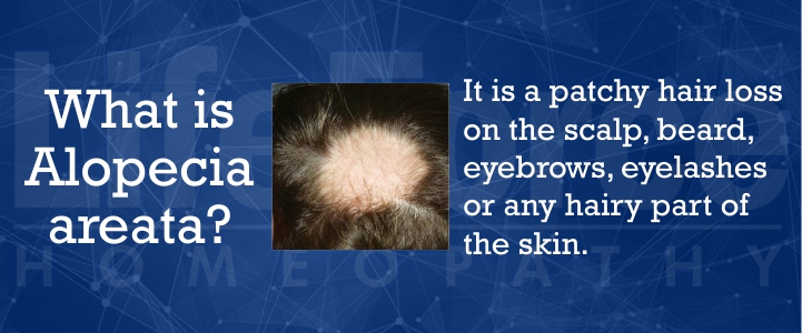 What is alopecia areata
